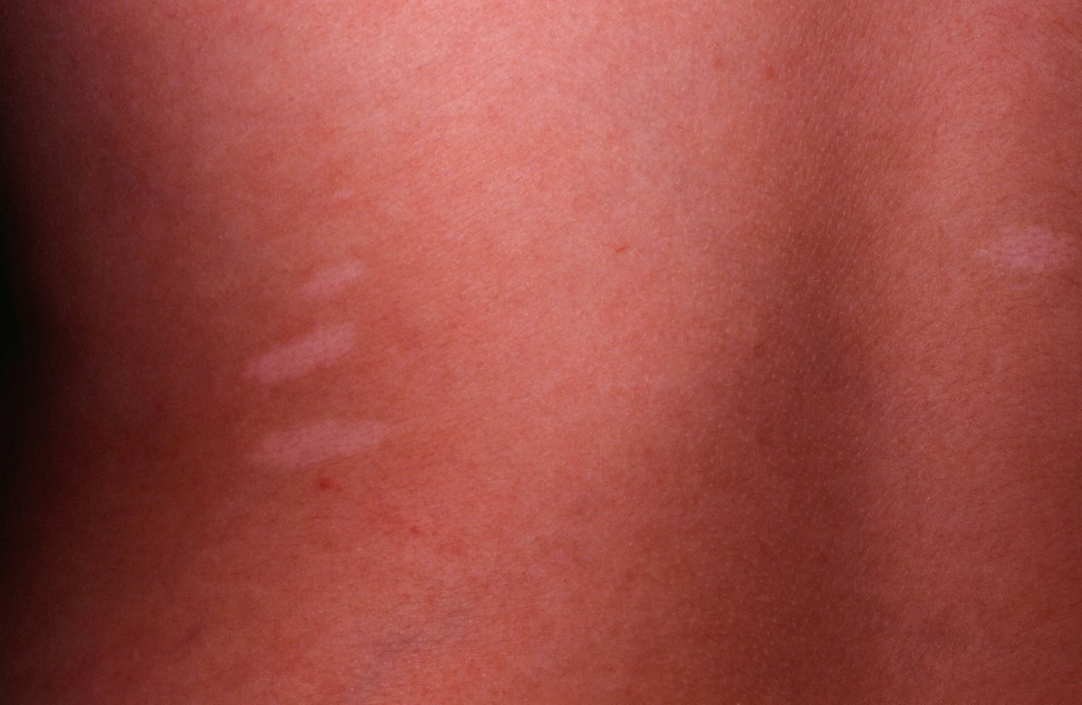 Ash-leaf spots
