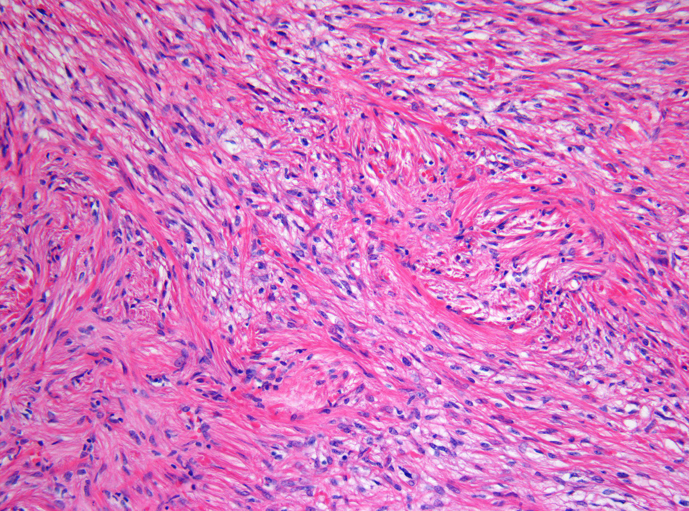 Pilocytic astrocytoma