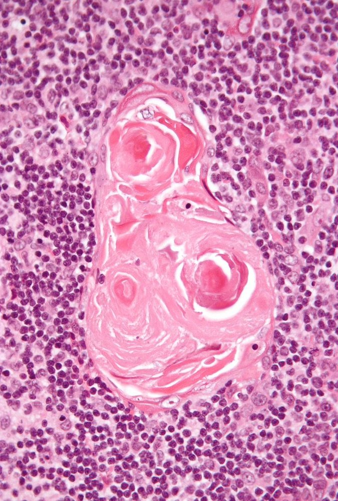 Hassal corpuscle (thymic corpuscle)