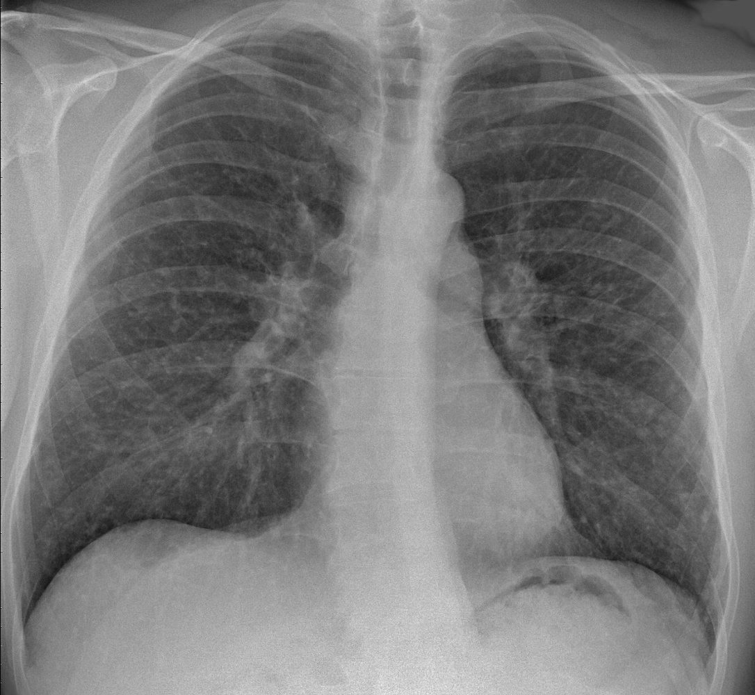 Thoracic sarcoidosis