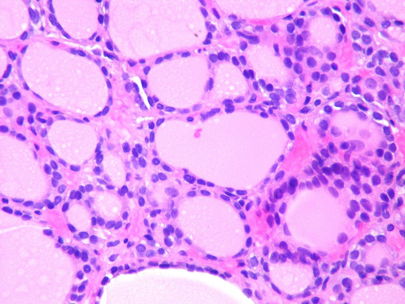 Follicular thyroid cancer