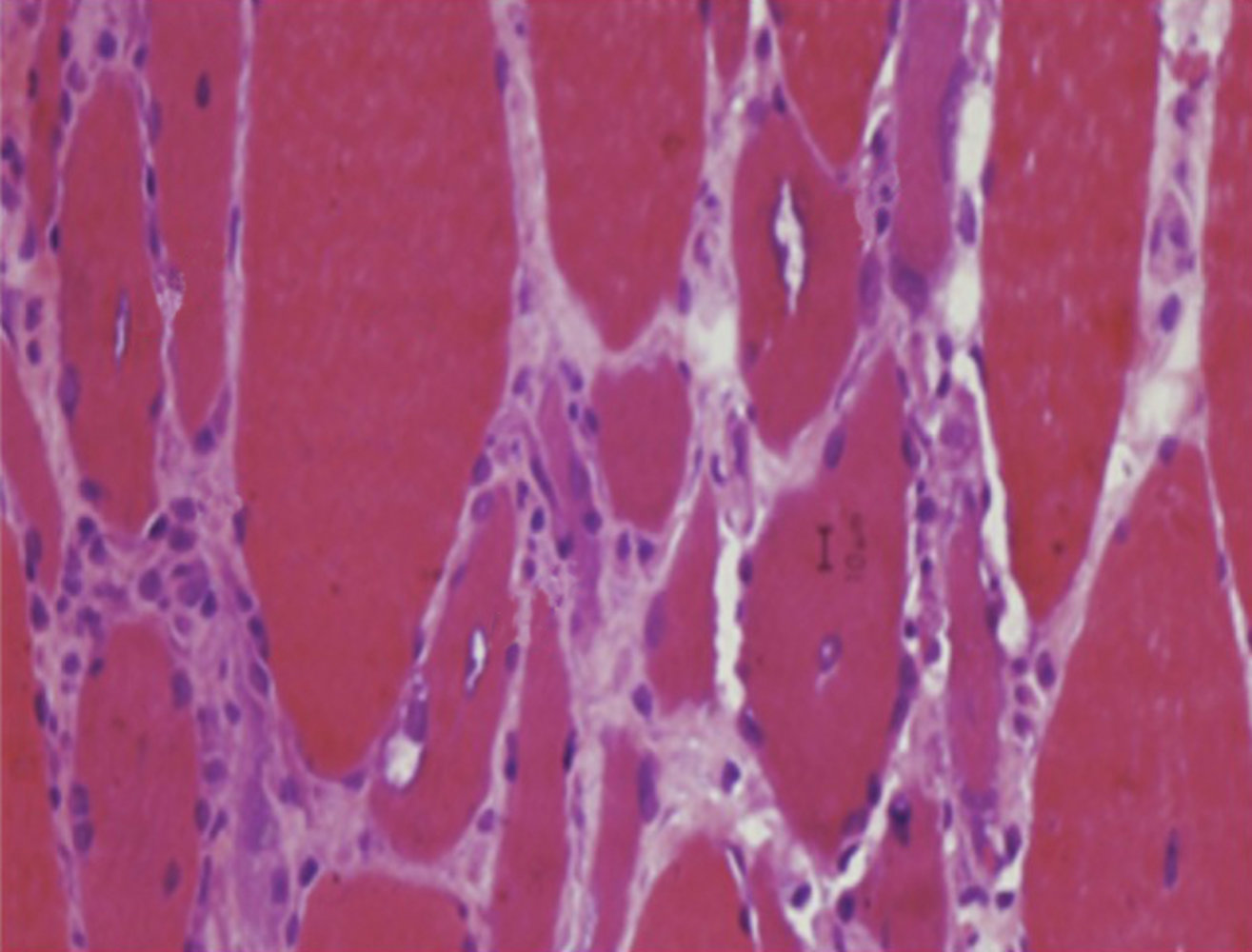 Inclusion body myositis