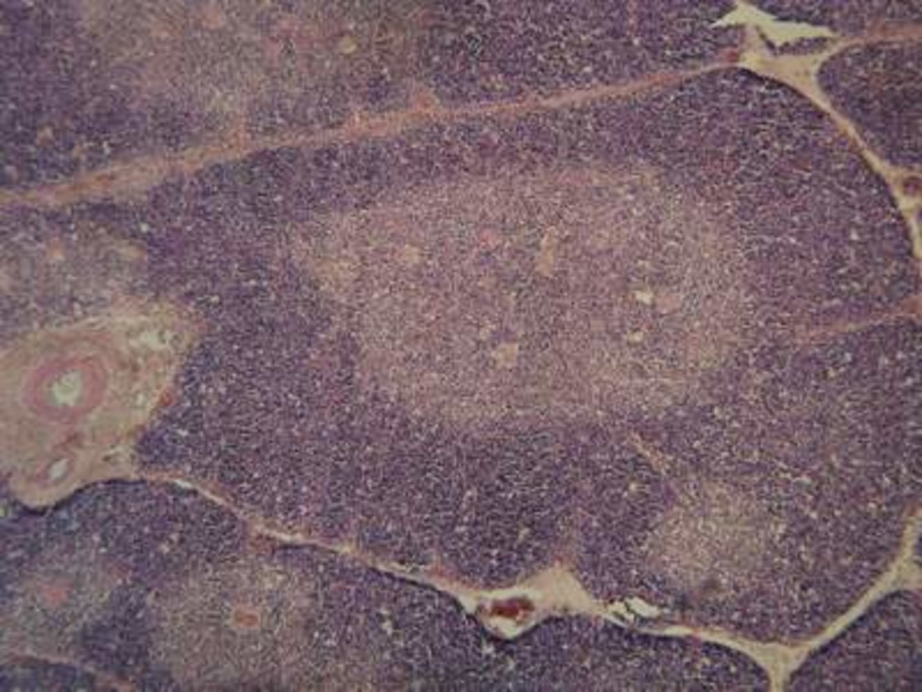 Thymus (child)