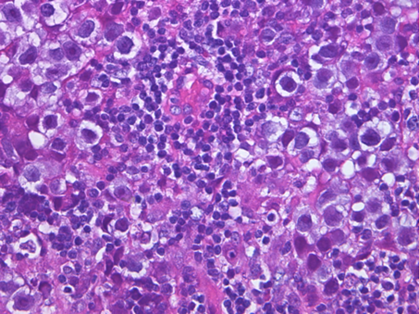 Pineal germinoma