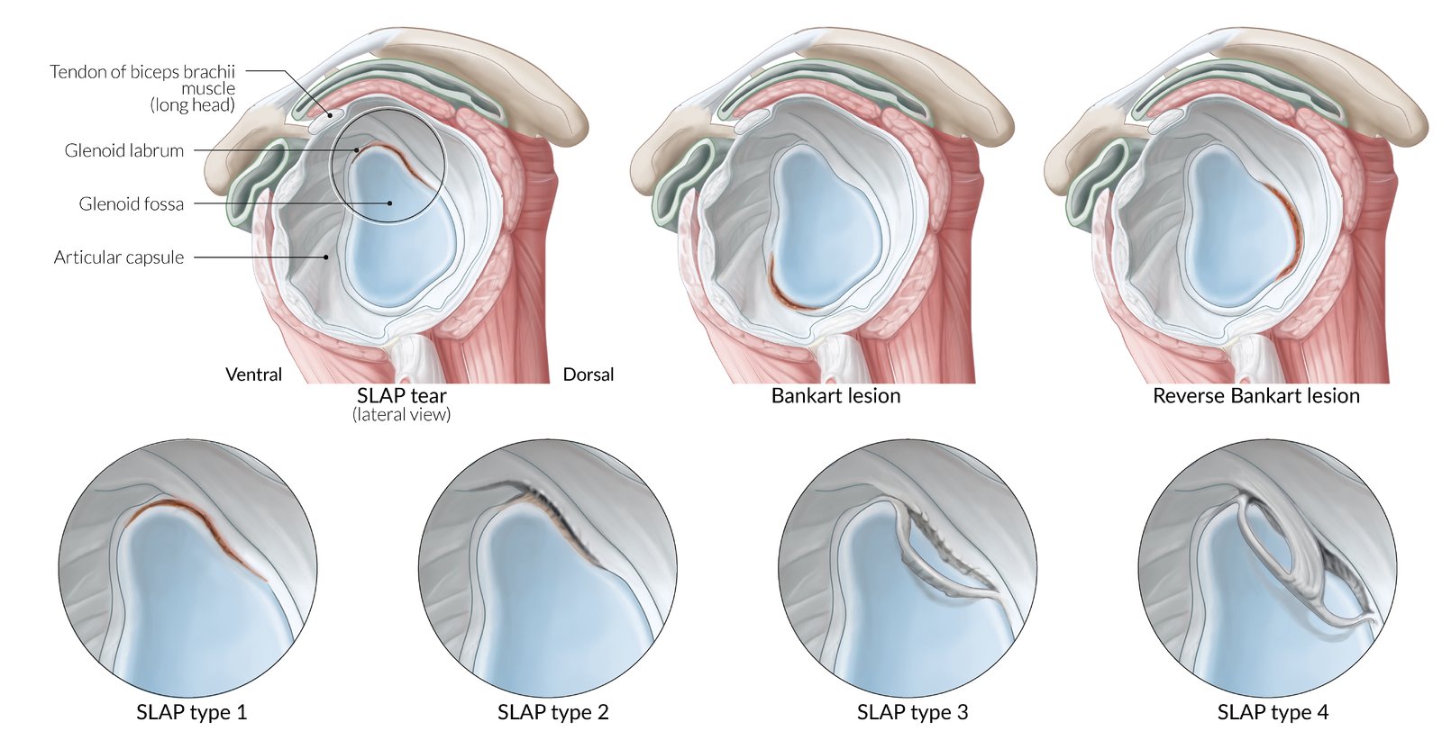 Labral tears of the shoulder organized by location