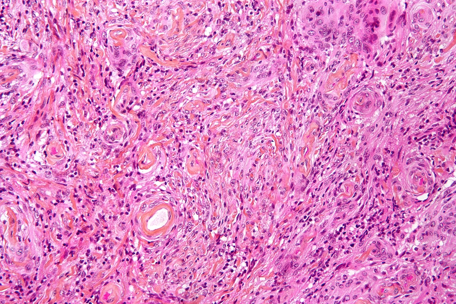 Meningioma