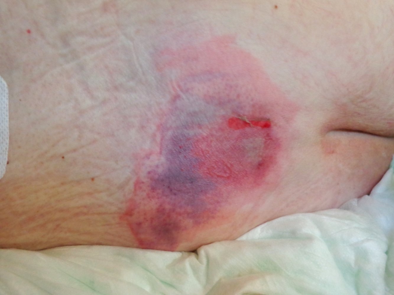 Stage 2 decubitus (pressure) ulcer
