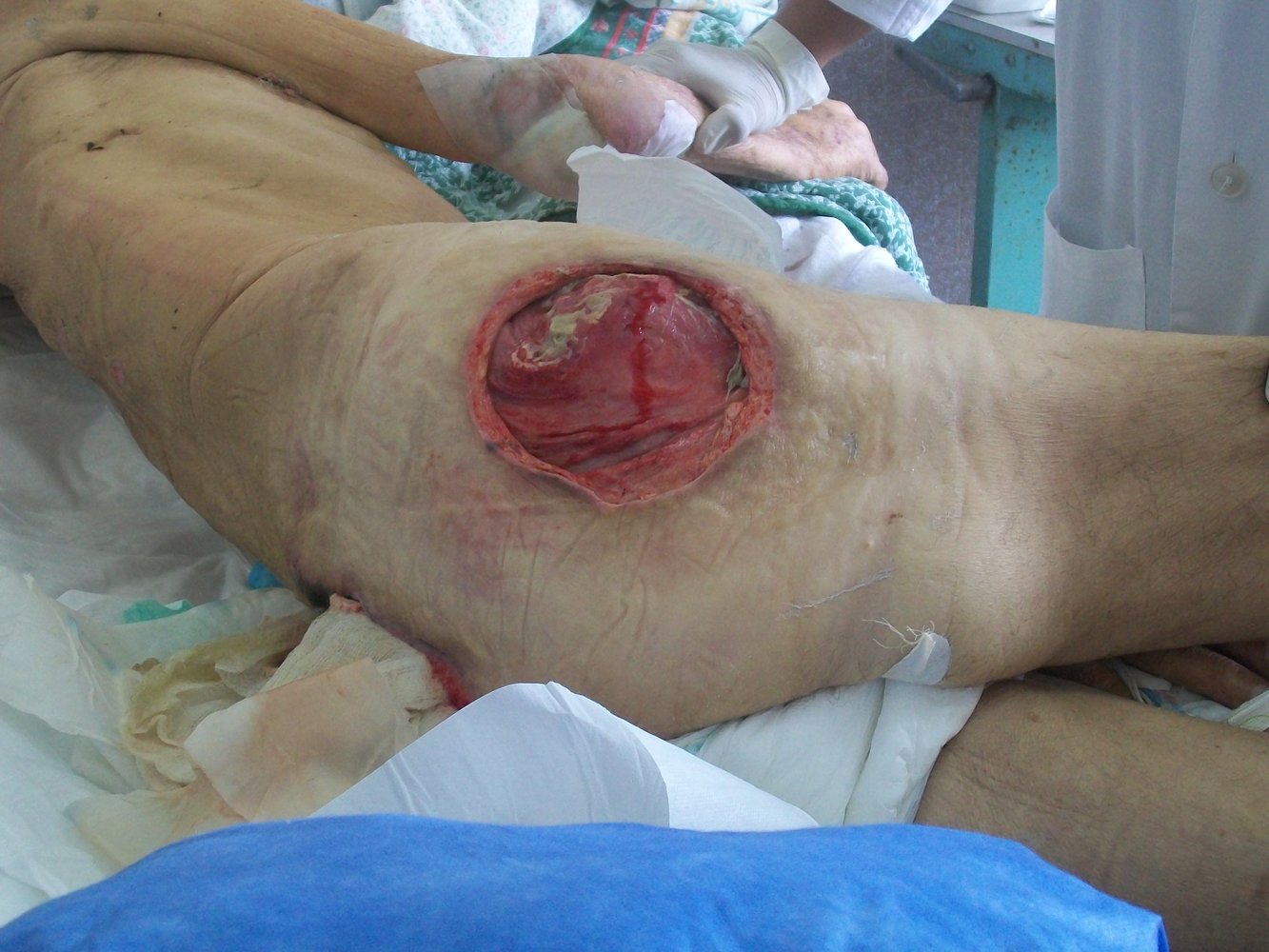 Stage 4 decubitus (pressure) ulcer