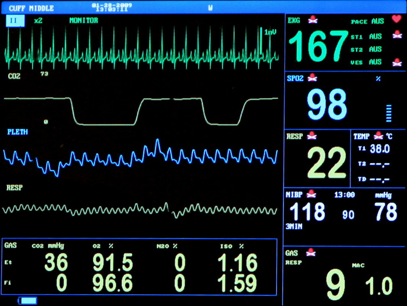 Anesthesia monitor