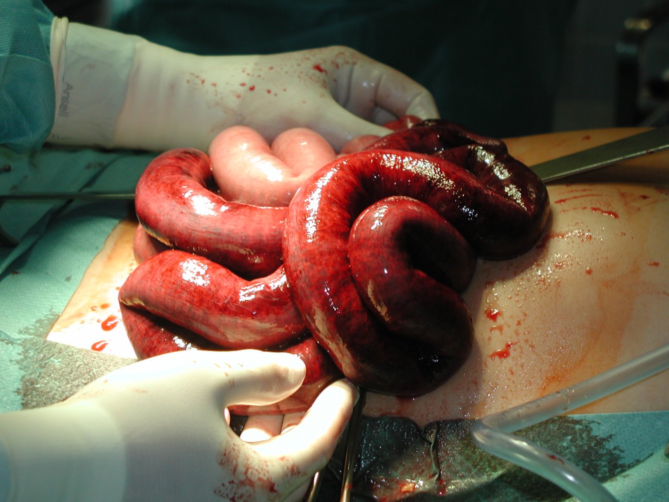 Small bowel ischemia