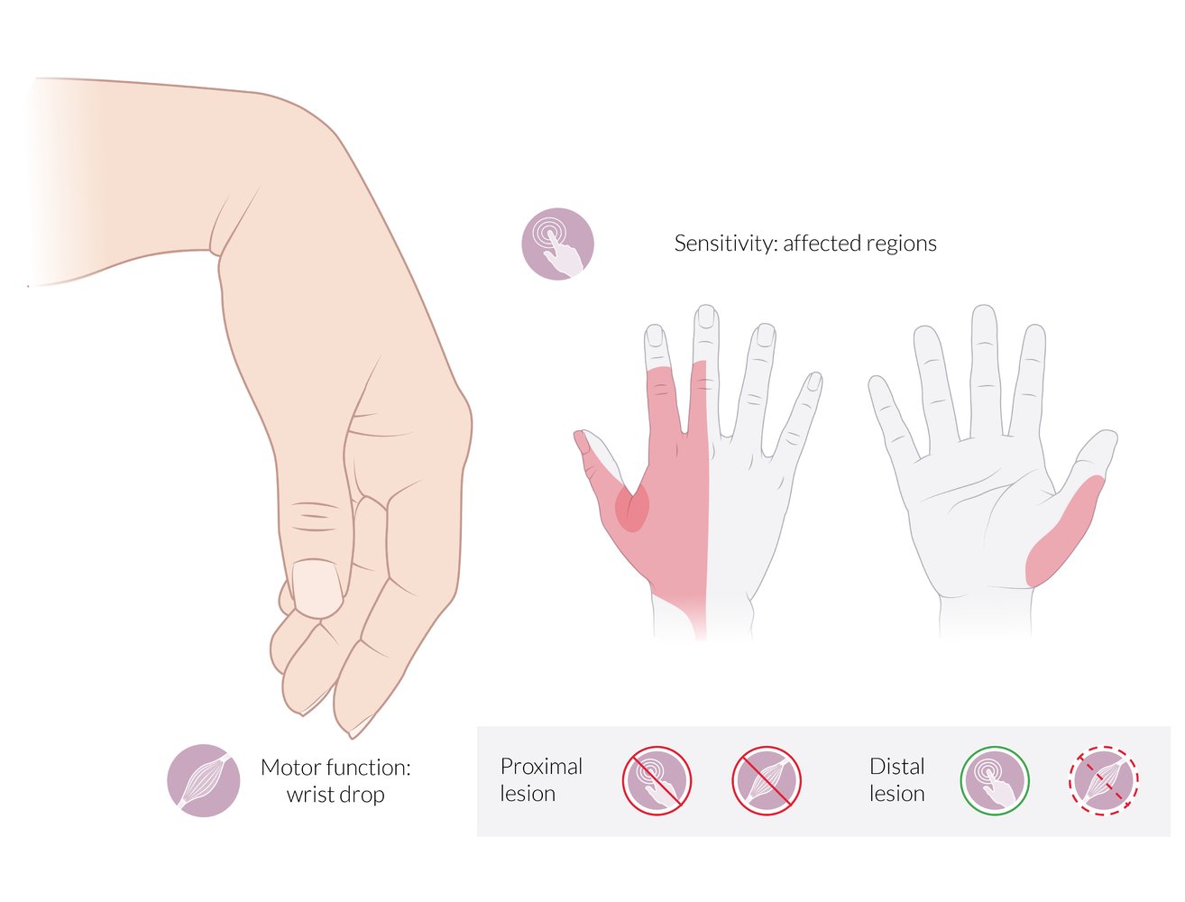 Radial nerve neuropathy