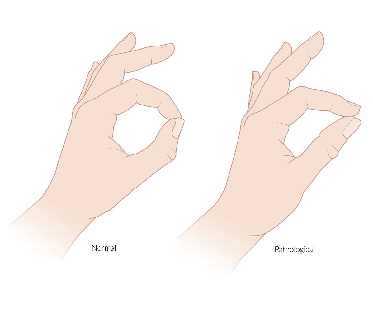 Pinch sign (anterior interosseous syndrome)