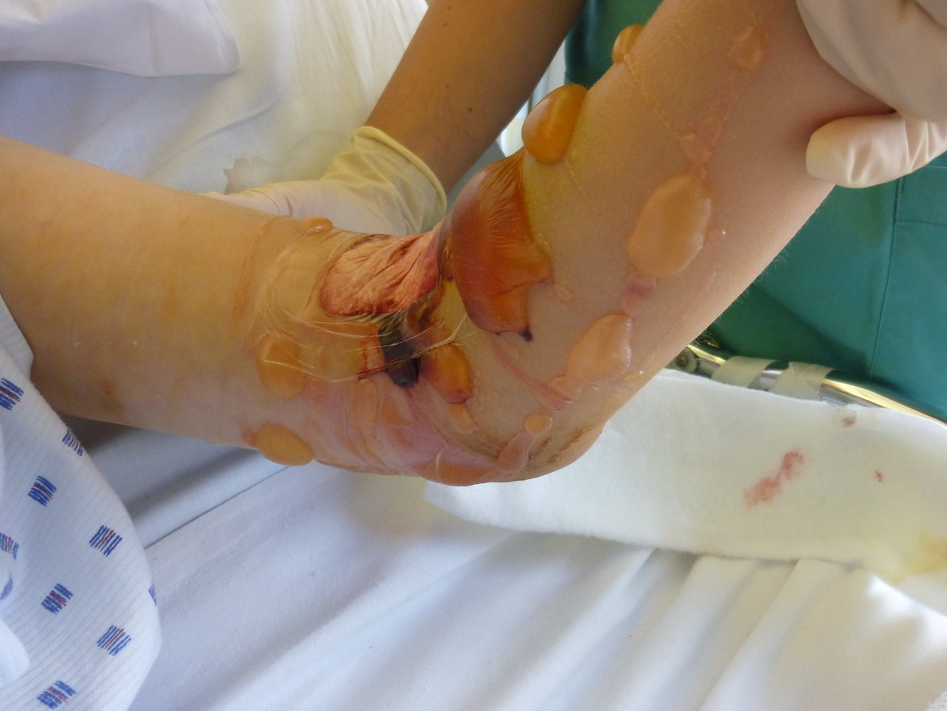 Compartment syndrome