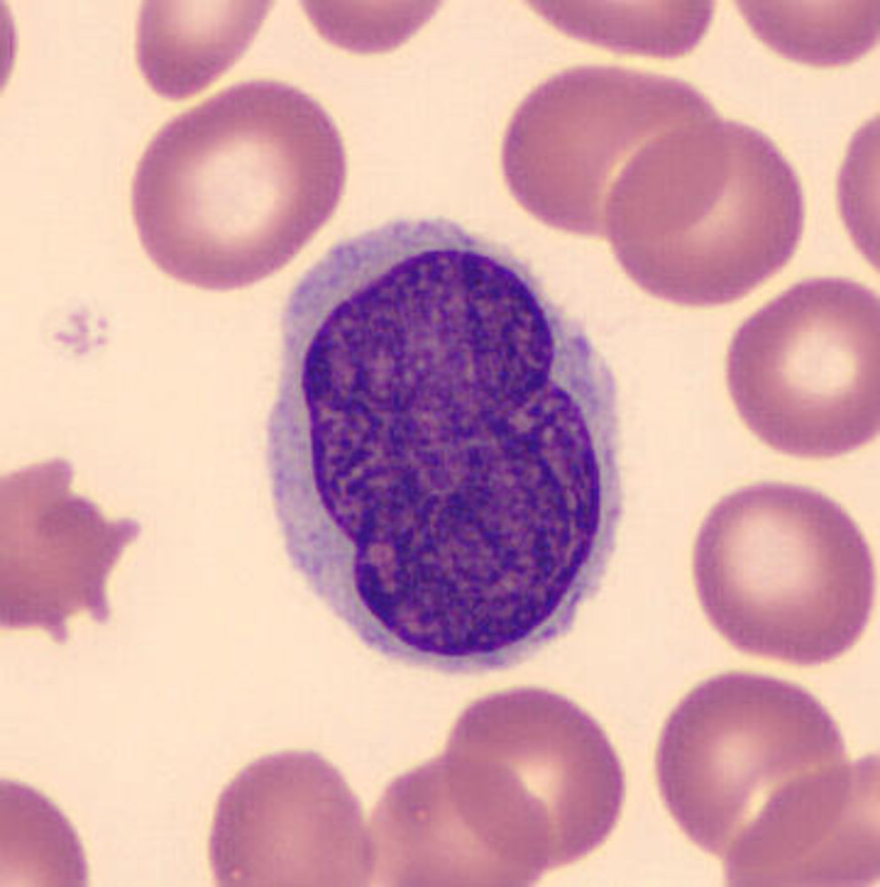 Sézary Cell