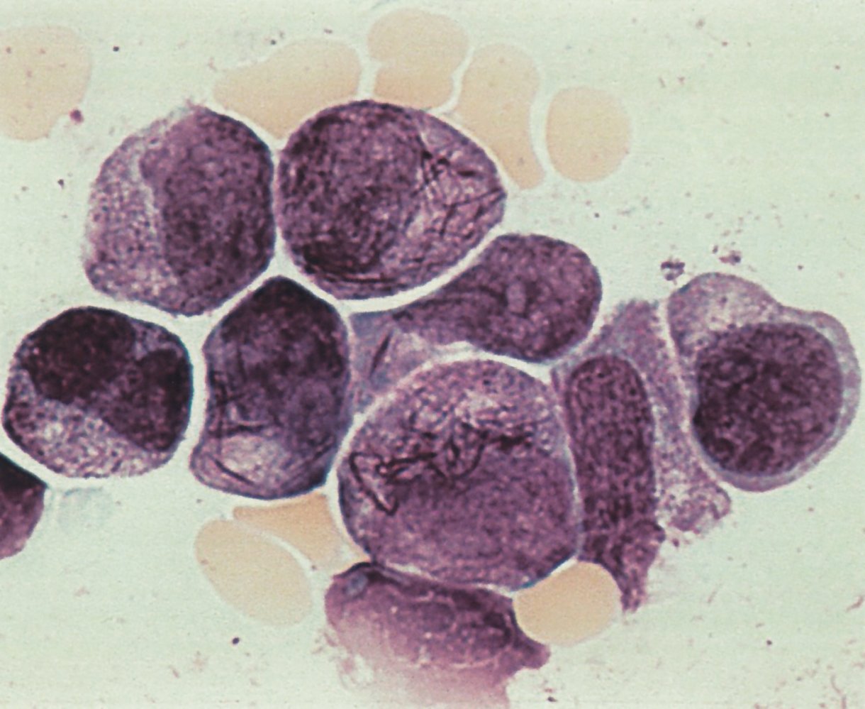 Acute promyelocytic leukemia