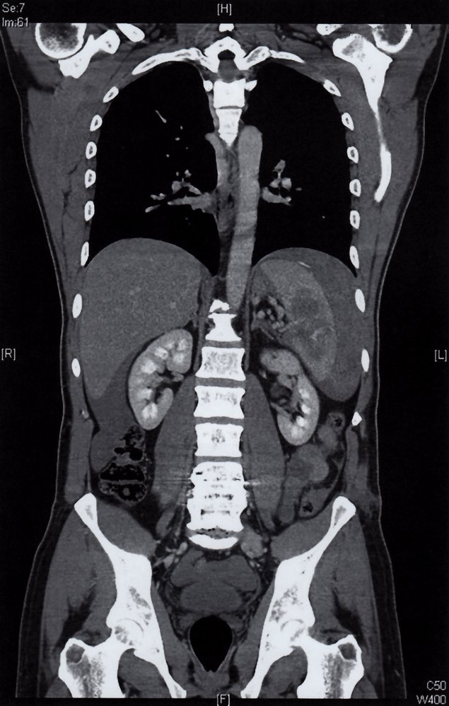 Splenic laceration
