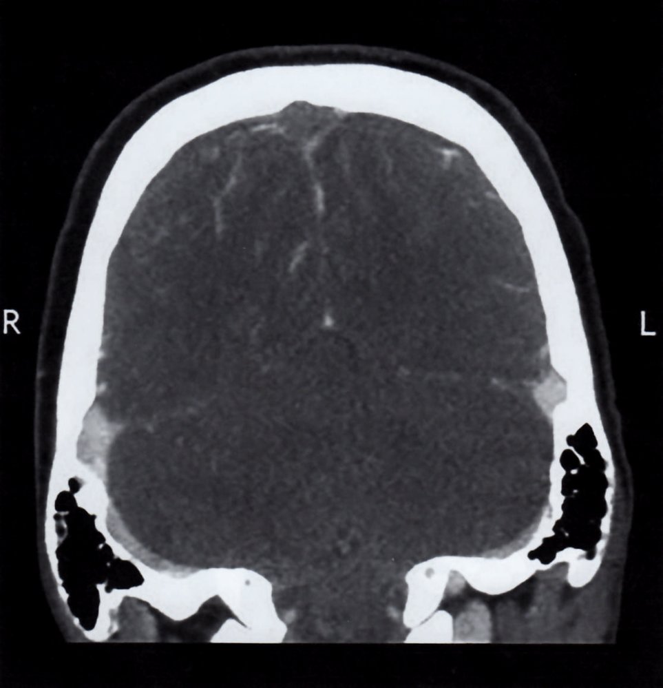 Sinus vein thrombosis