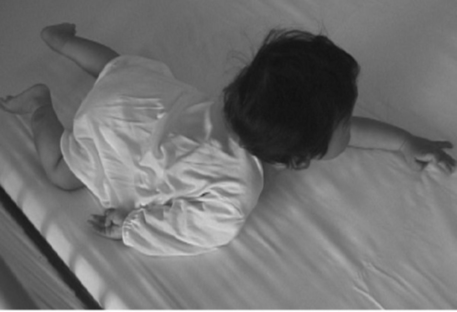 Erb palsy (waiter's tip posture)