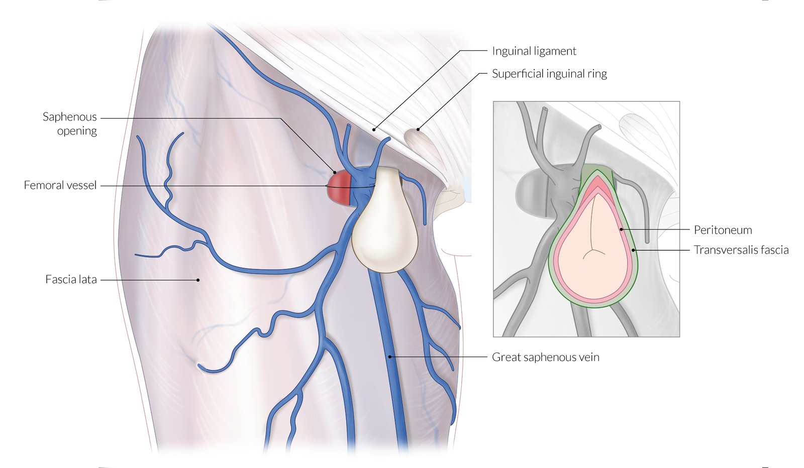 Femoral hernia