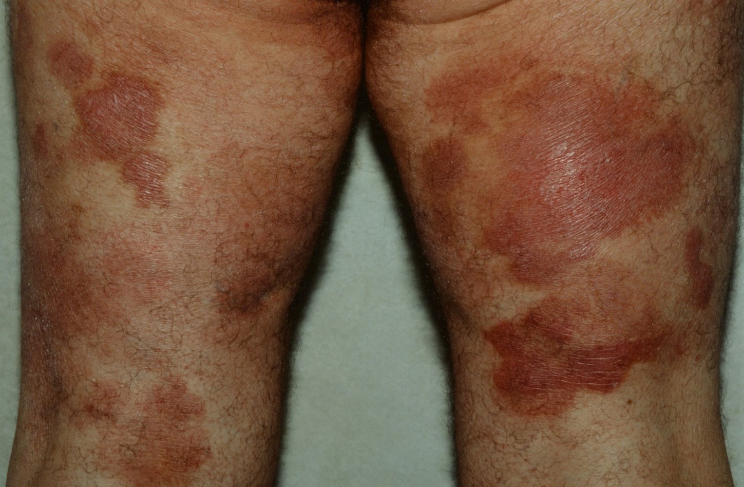 Mycosis fungoides