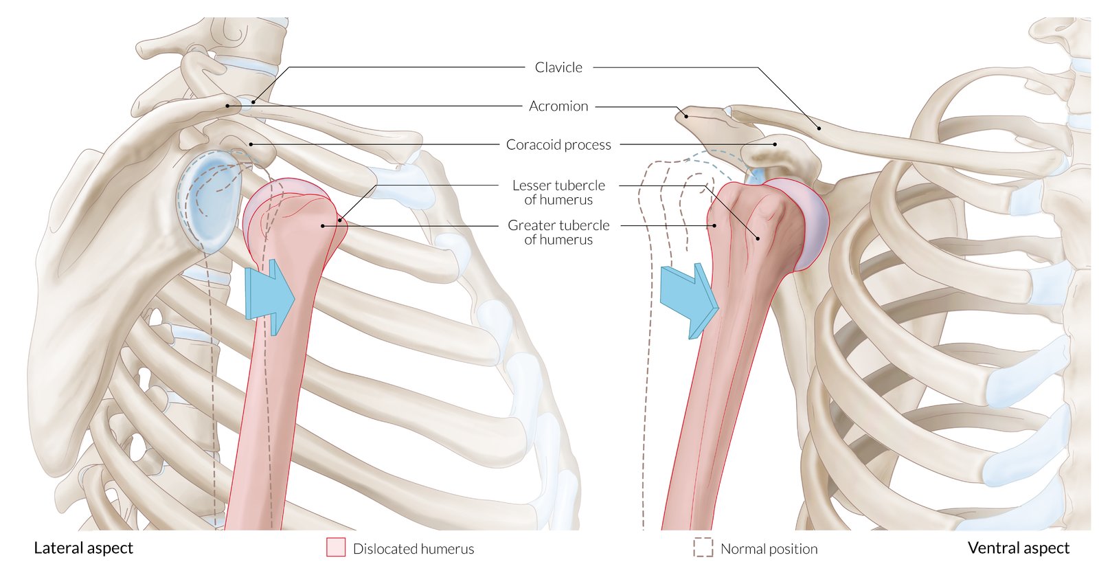 Anterior shoulder dislocation skeletal anatomy