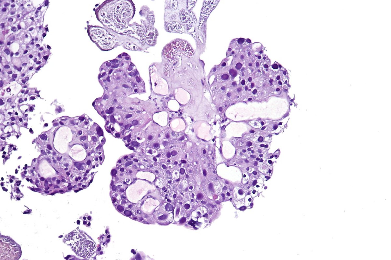 Papillary urothelial carcinoma