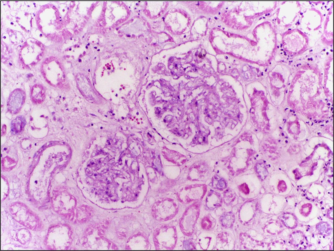 Renal infarction