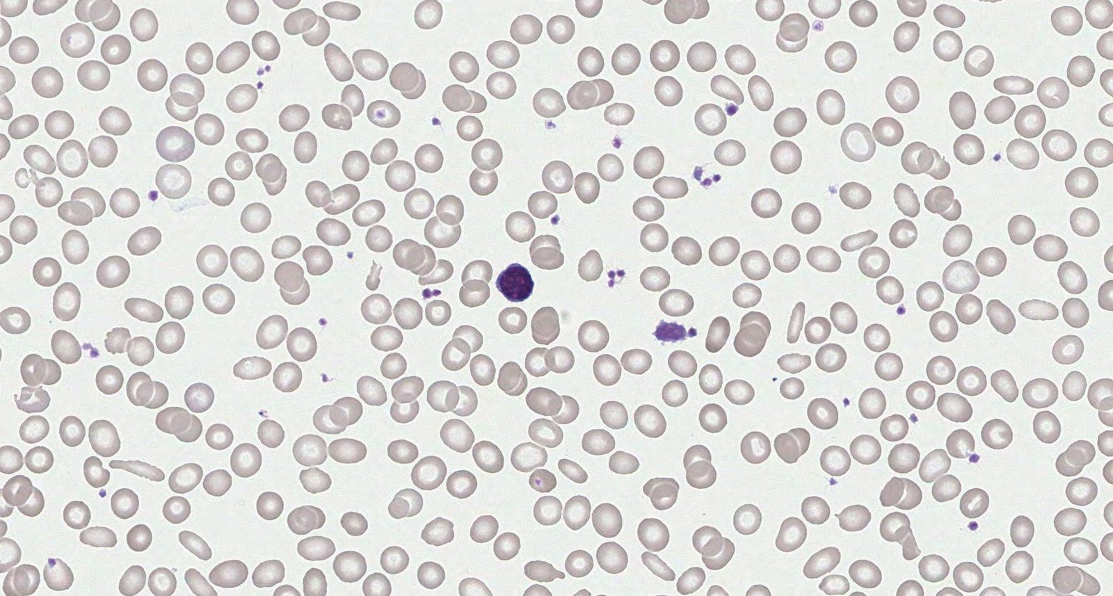 Iron deficiency anemia