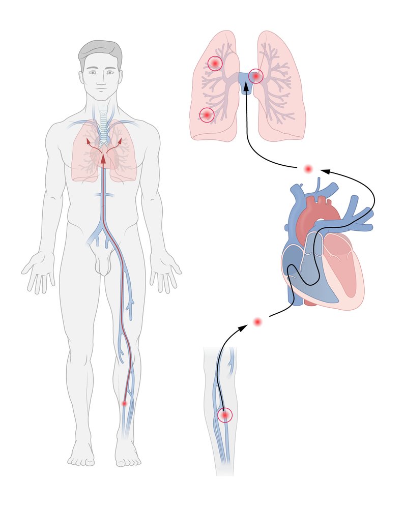 Pulmonary embolism: thrombus formation and embolization