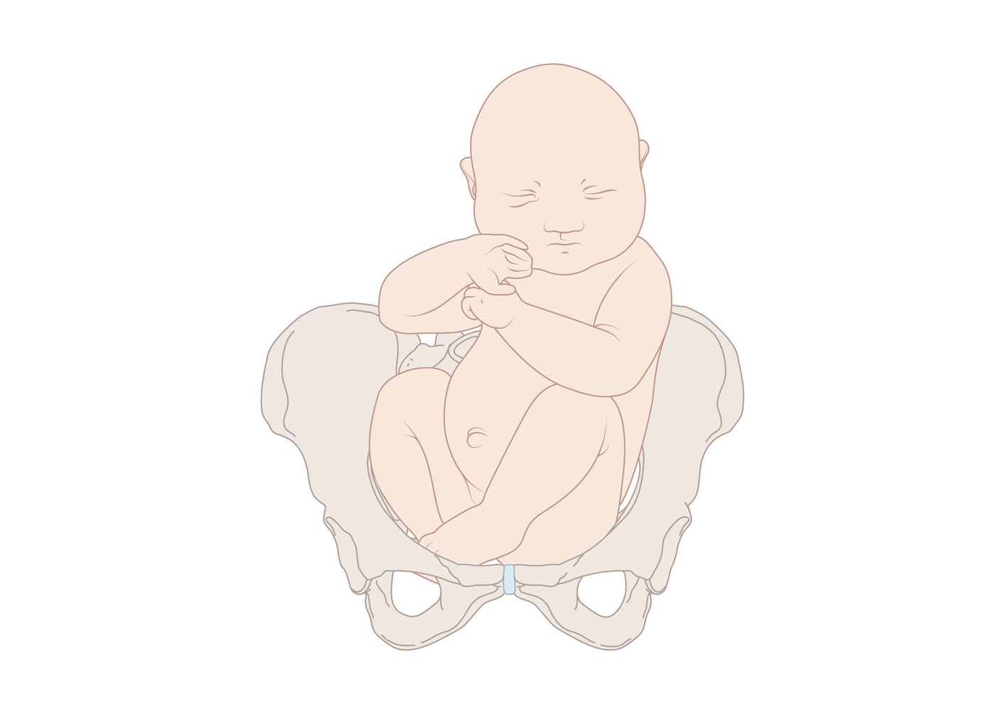 Types of breech presentation: complete breech