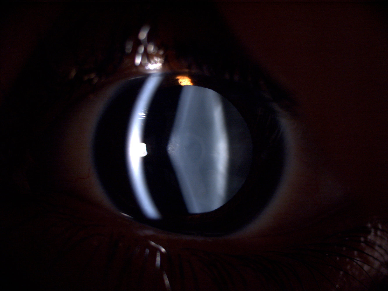 Anterior lenticonus in Alport syndrome