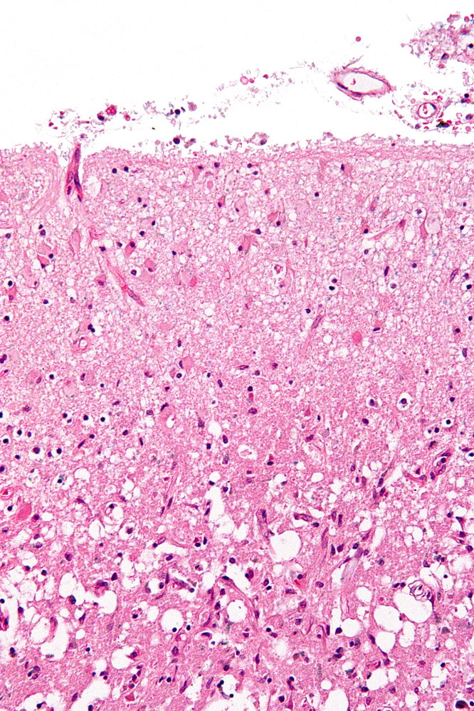 Reactive gliosis