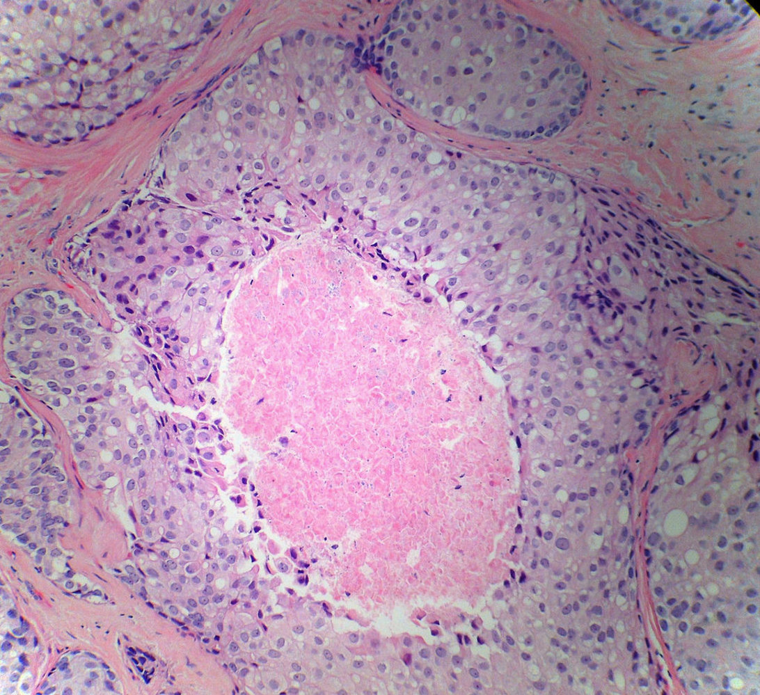 Comedocarcinoma