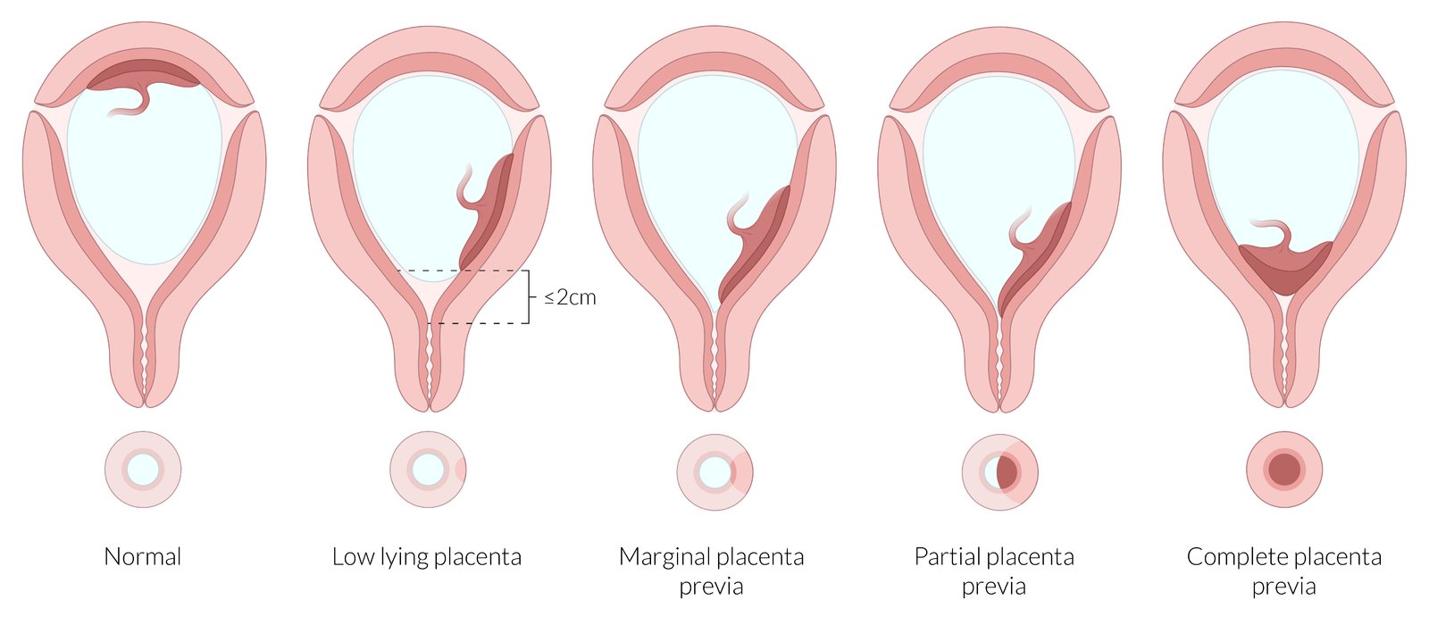 Types of placenta previa