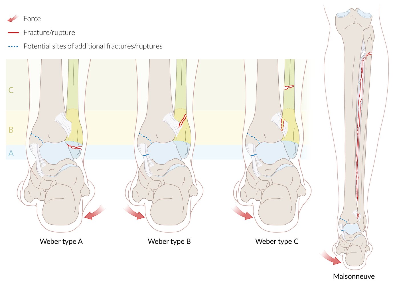 Weber classification of ankle fractures