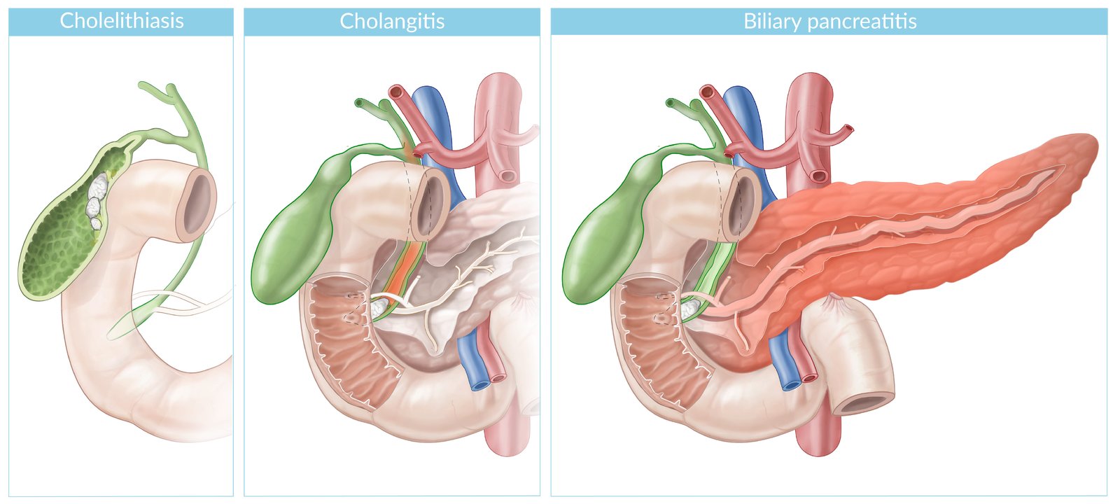 Cholelithiasis, cholangitis, and biliary pancreatitis