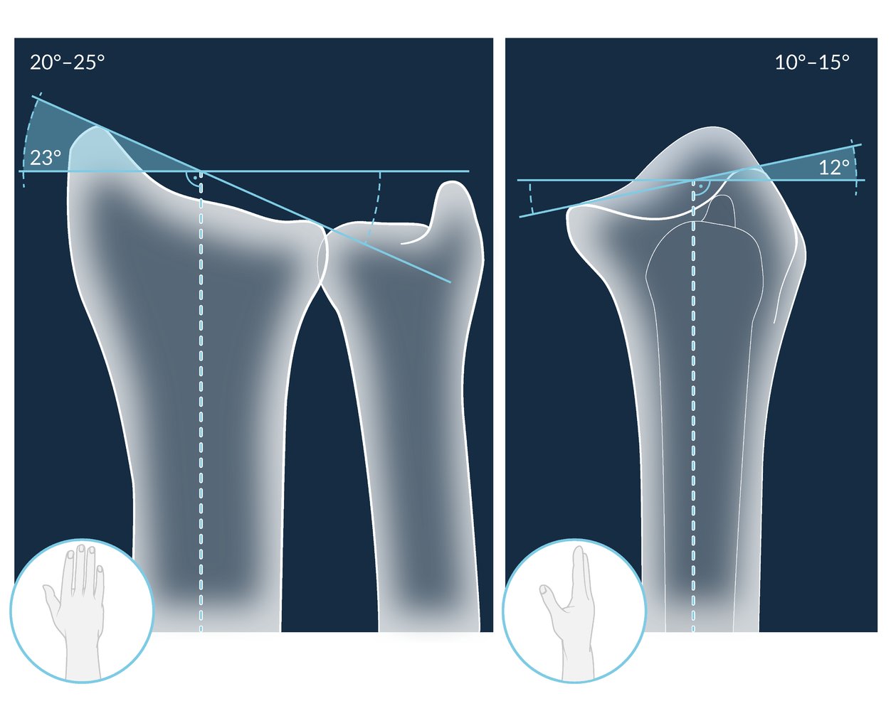 Radial inclination in PA view