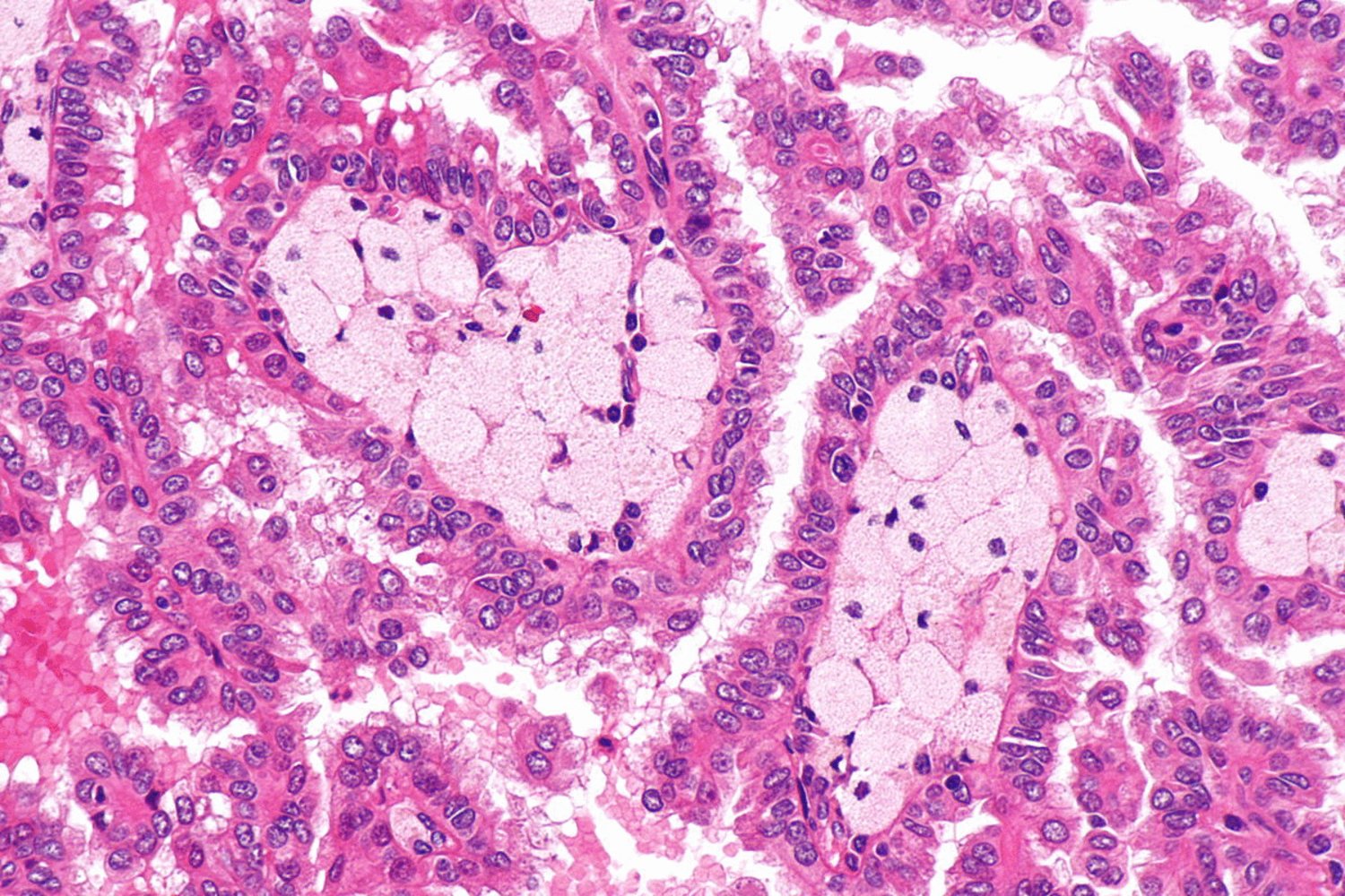 Papillary renal cell carcinoma type 2