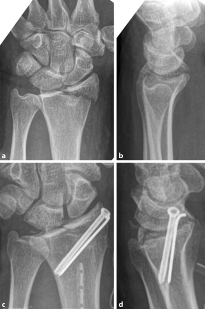 K-wire fixation in distal radius fracture