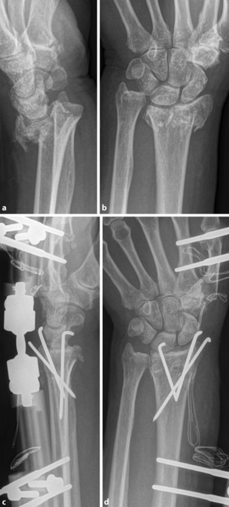 External fixation in distal radius fracture