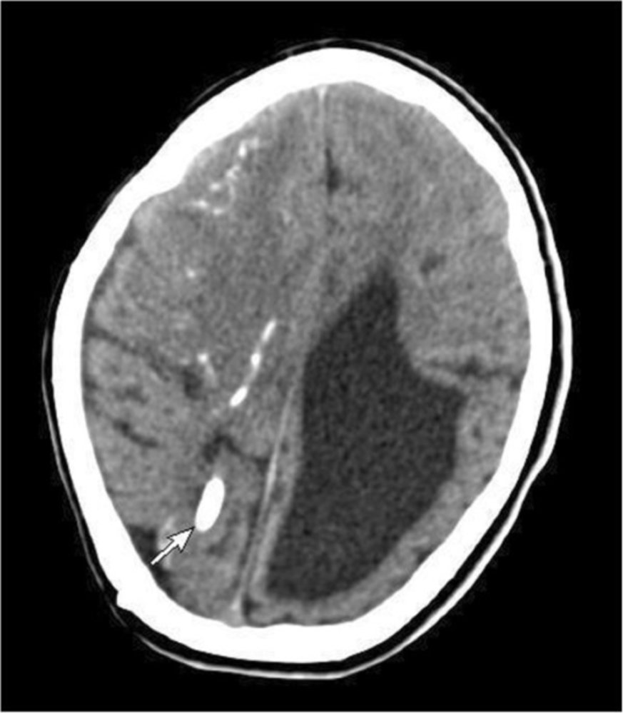 Congenital toxoplasmosis