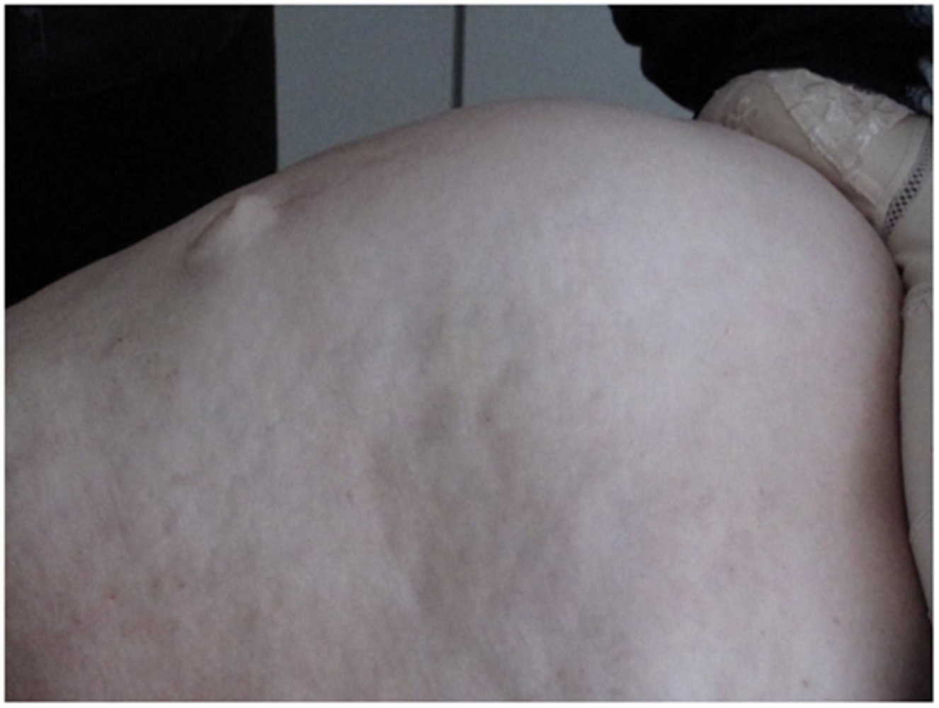 Epigastric hernia