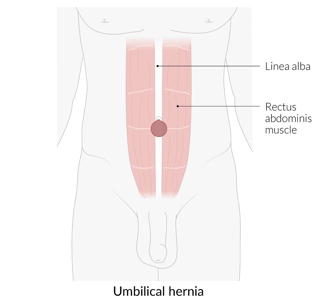 Umbilical hernia