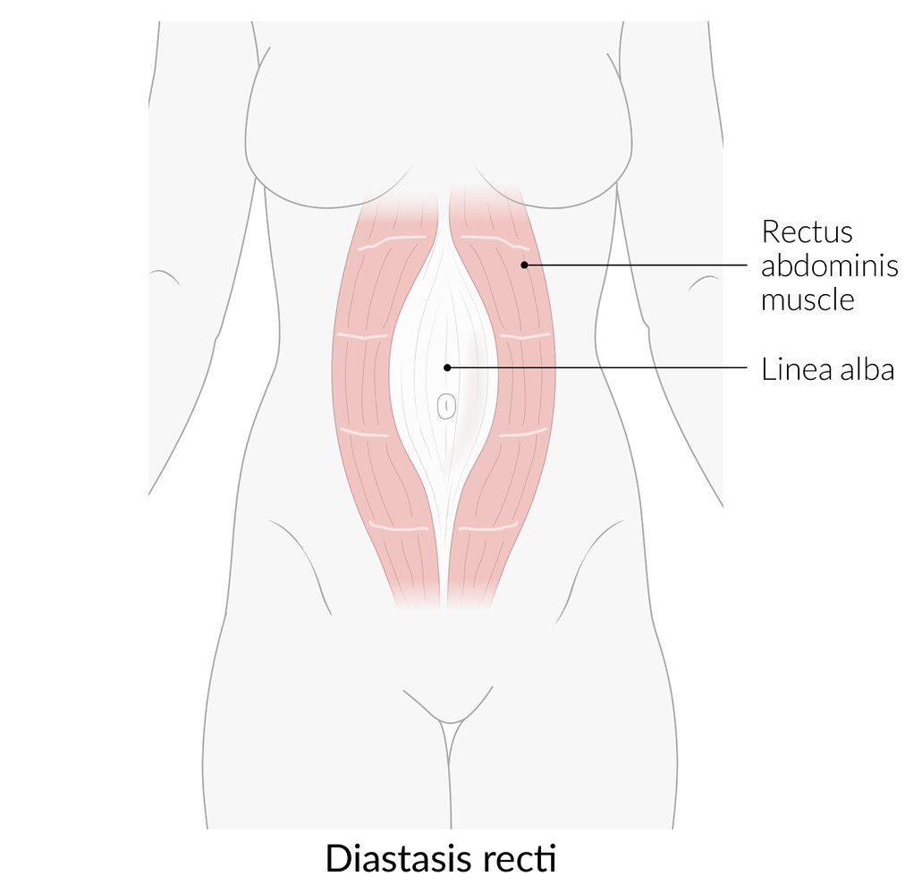Diastasis recti