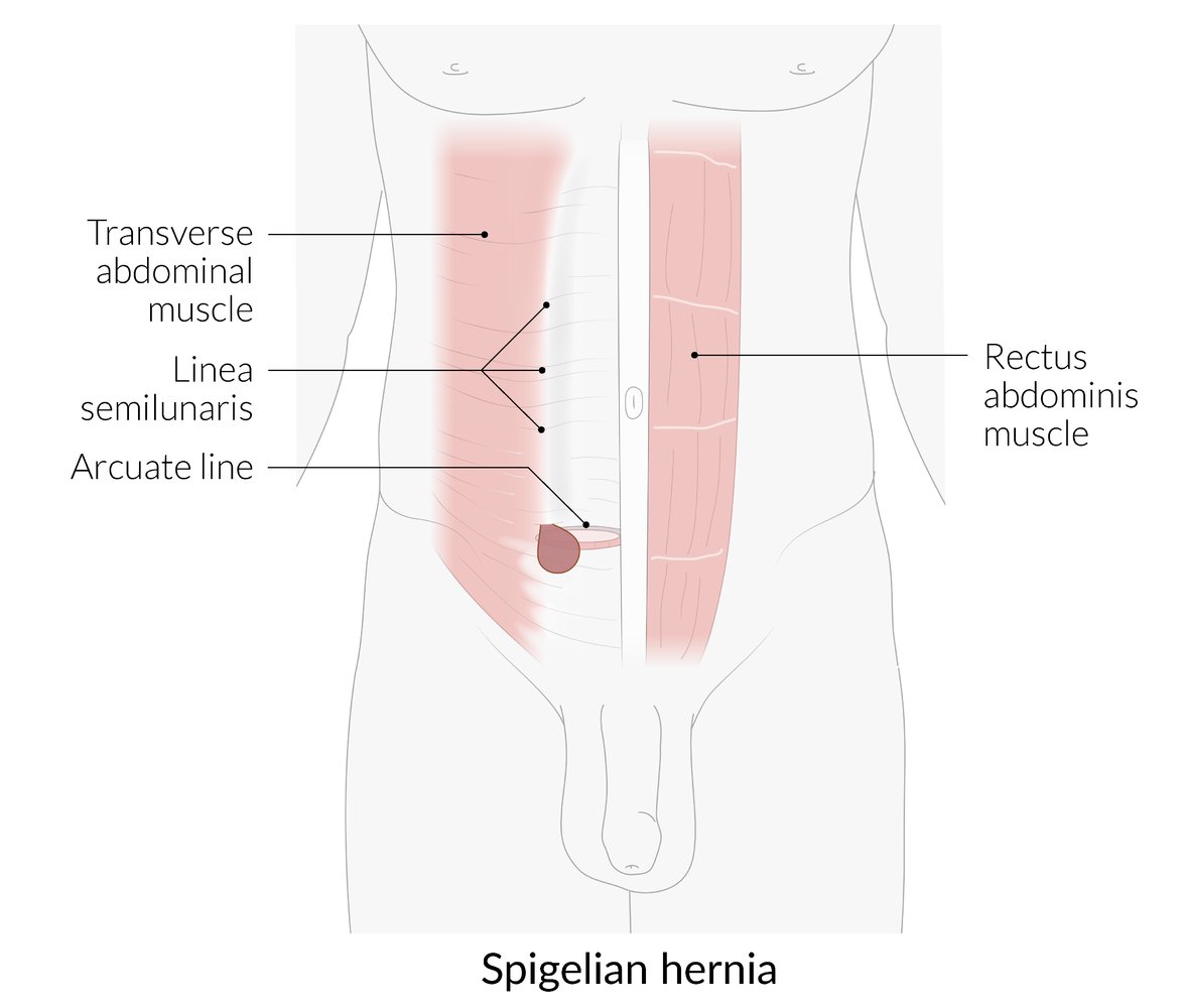 Spigelian hernia
