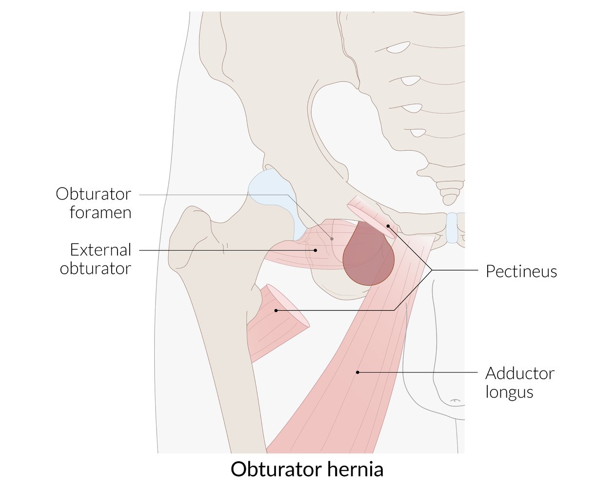 Obturator hernia