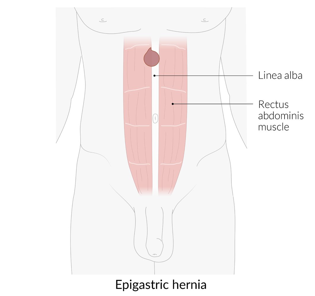 Epigastric hernia
