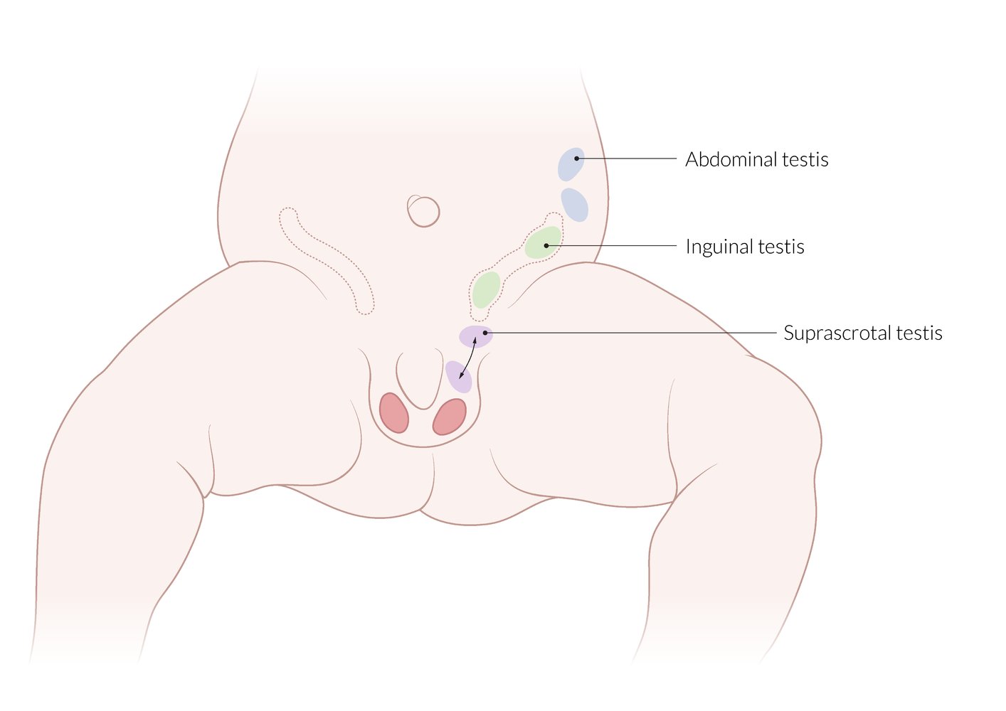Cryptorchidism