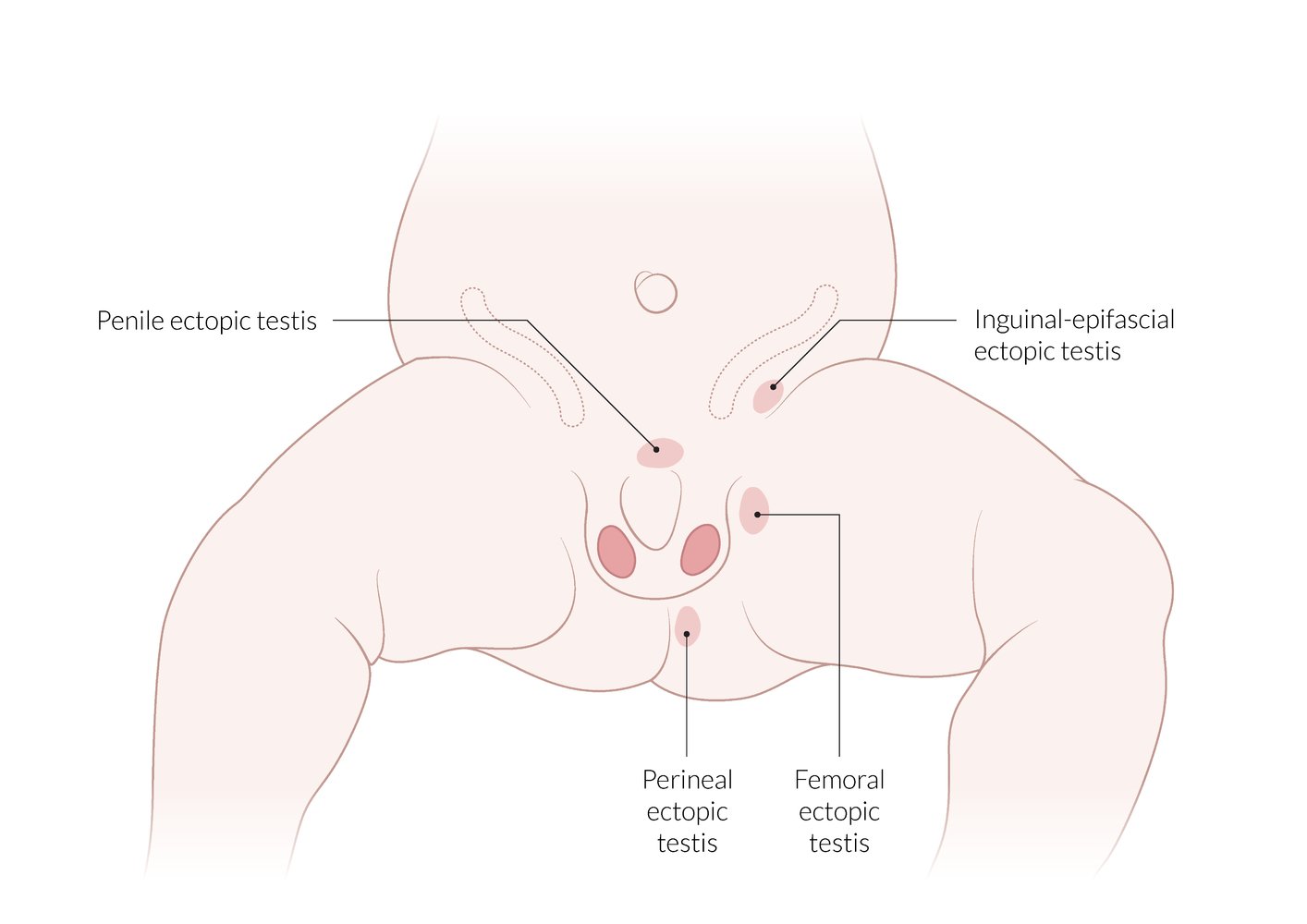 Ectopic testis