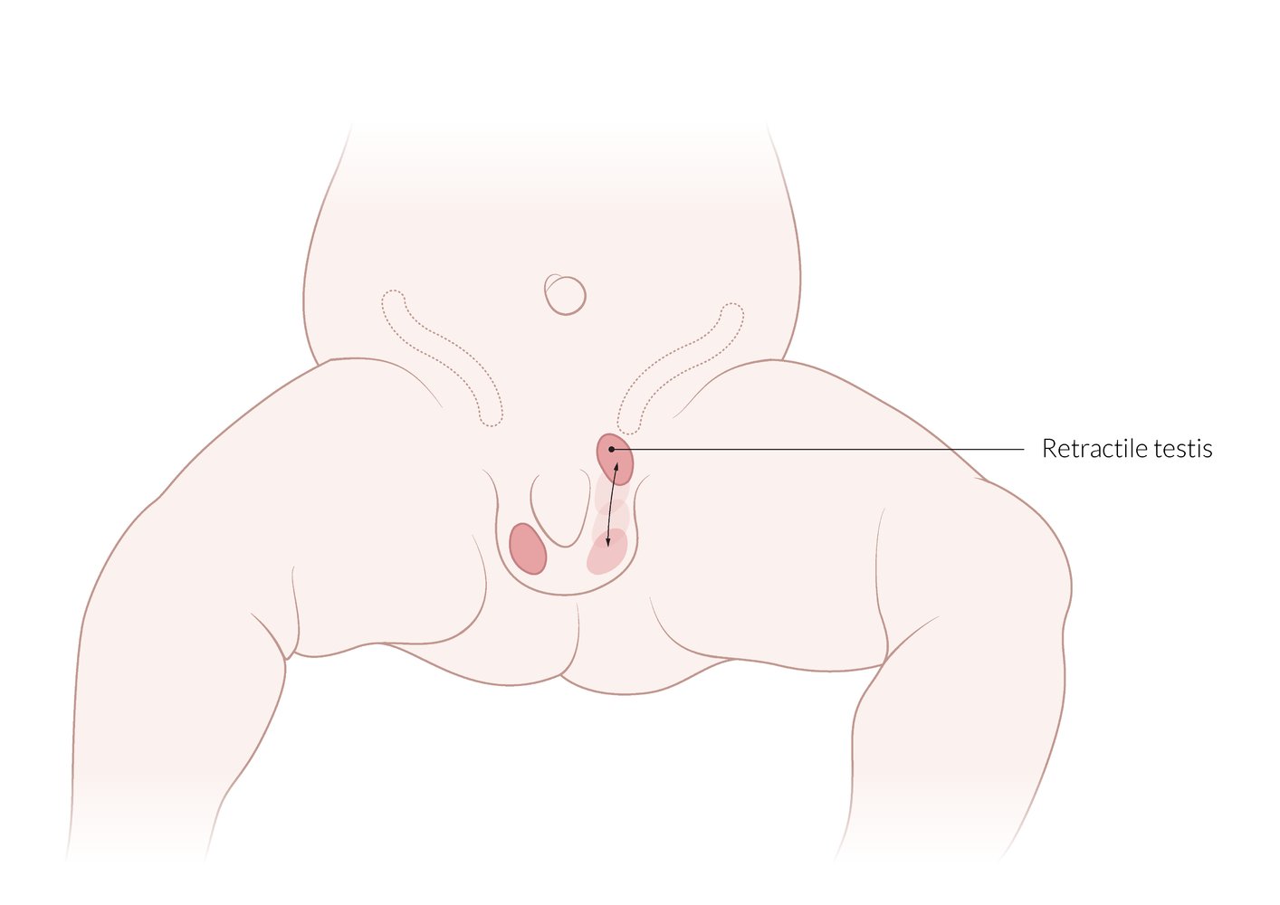 Retractile testis